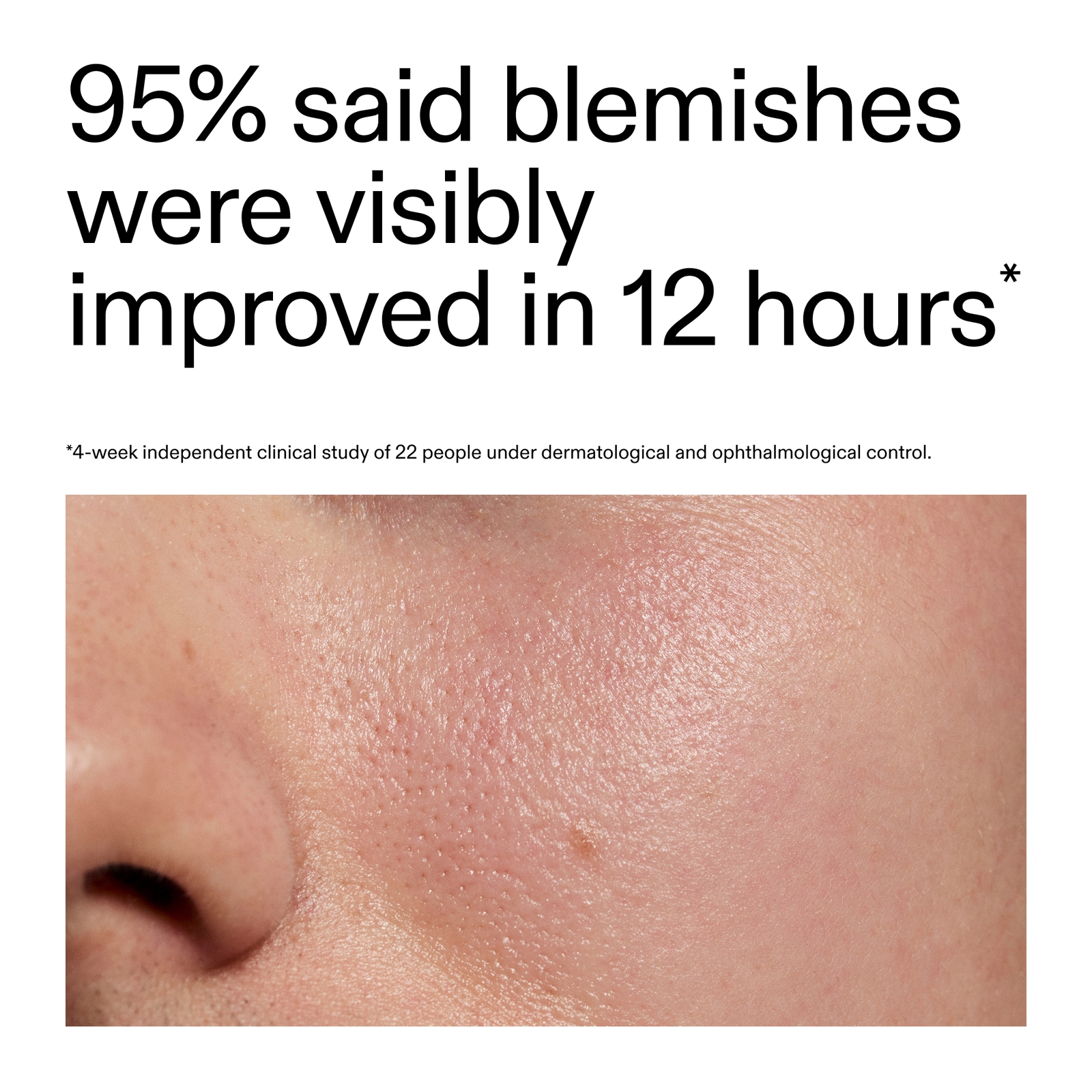 Thumbnail - The INKEY List Succinic Acid Blemish Treatment 15ml
