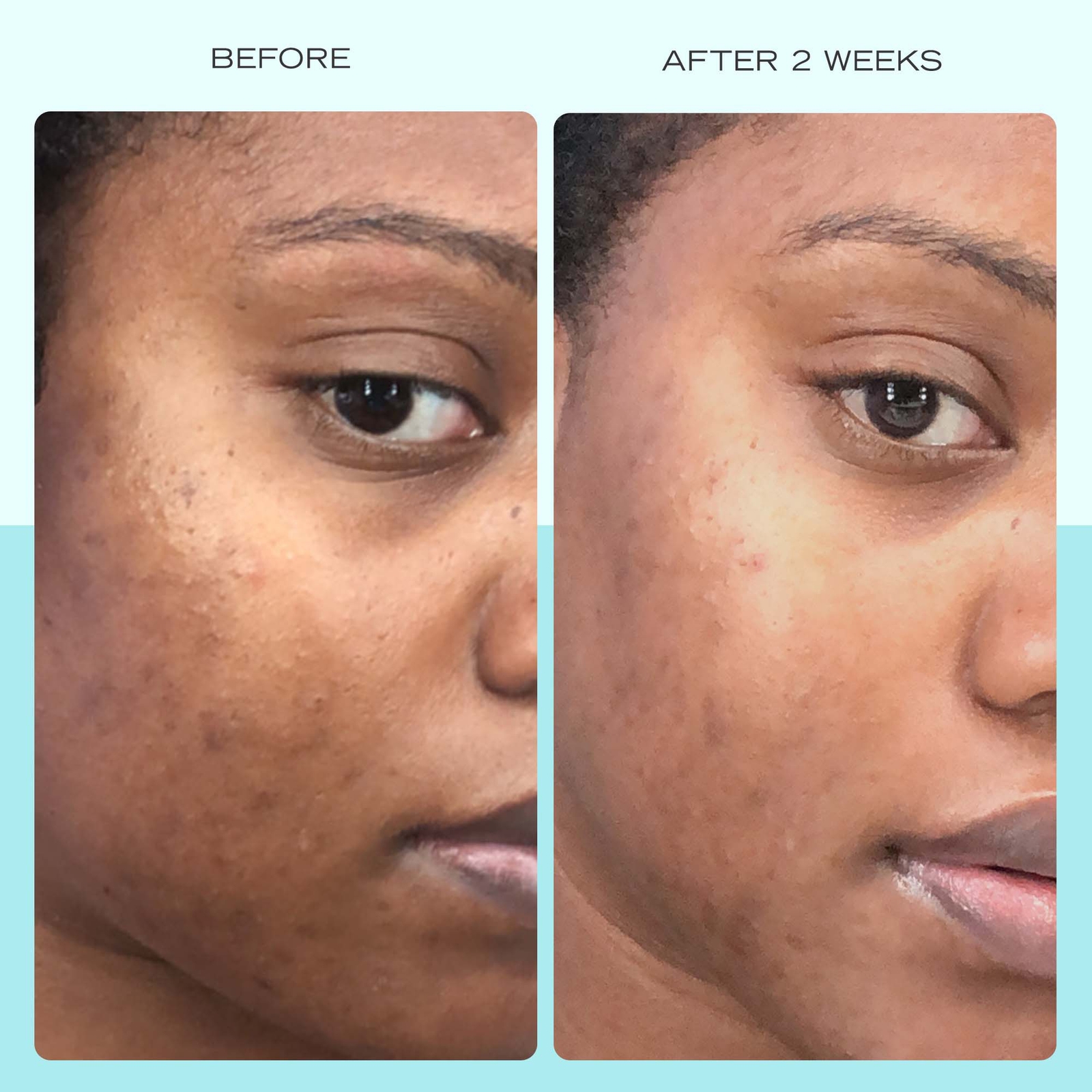 Thumbnail - First Aid Beauty Dark Spot Serum with Niacinamide 30ml