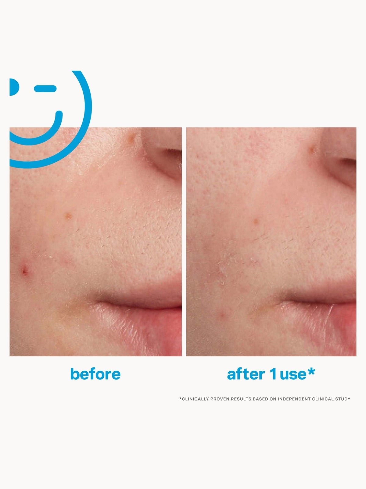 Kate Somerville EradiKate Blemish Treatment 30ml 2