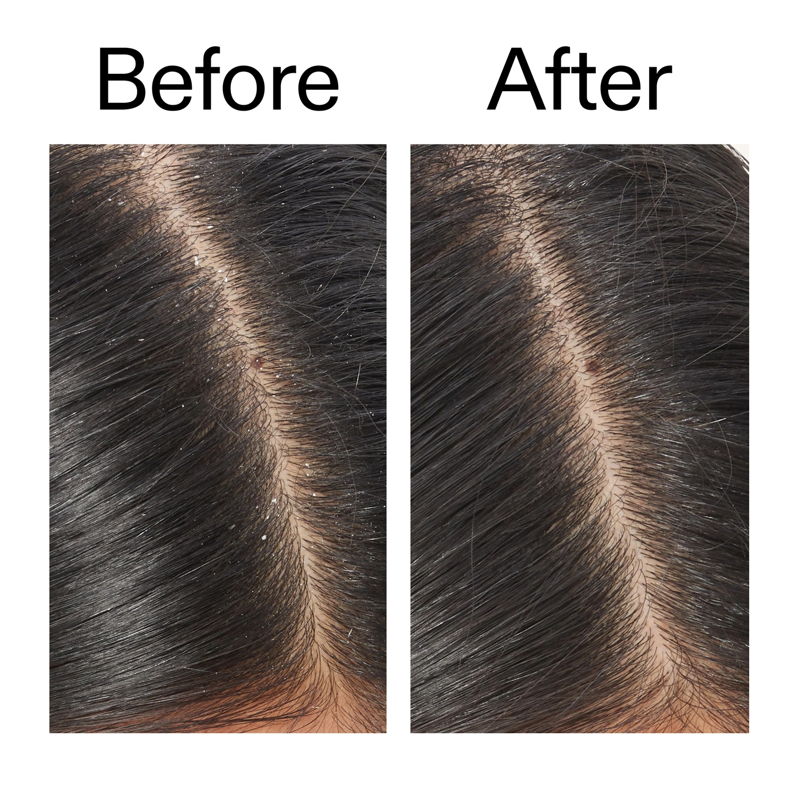 Thumbnail - The INKEY List Salicylic Acid Exfoliating Scalp Treatment 150ml