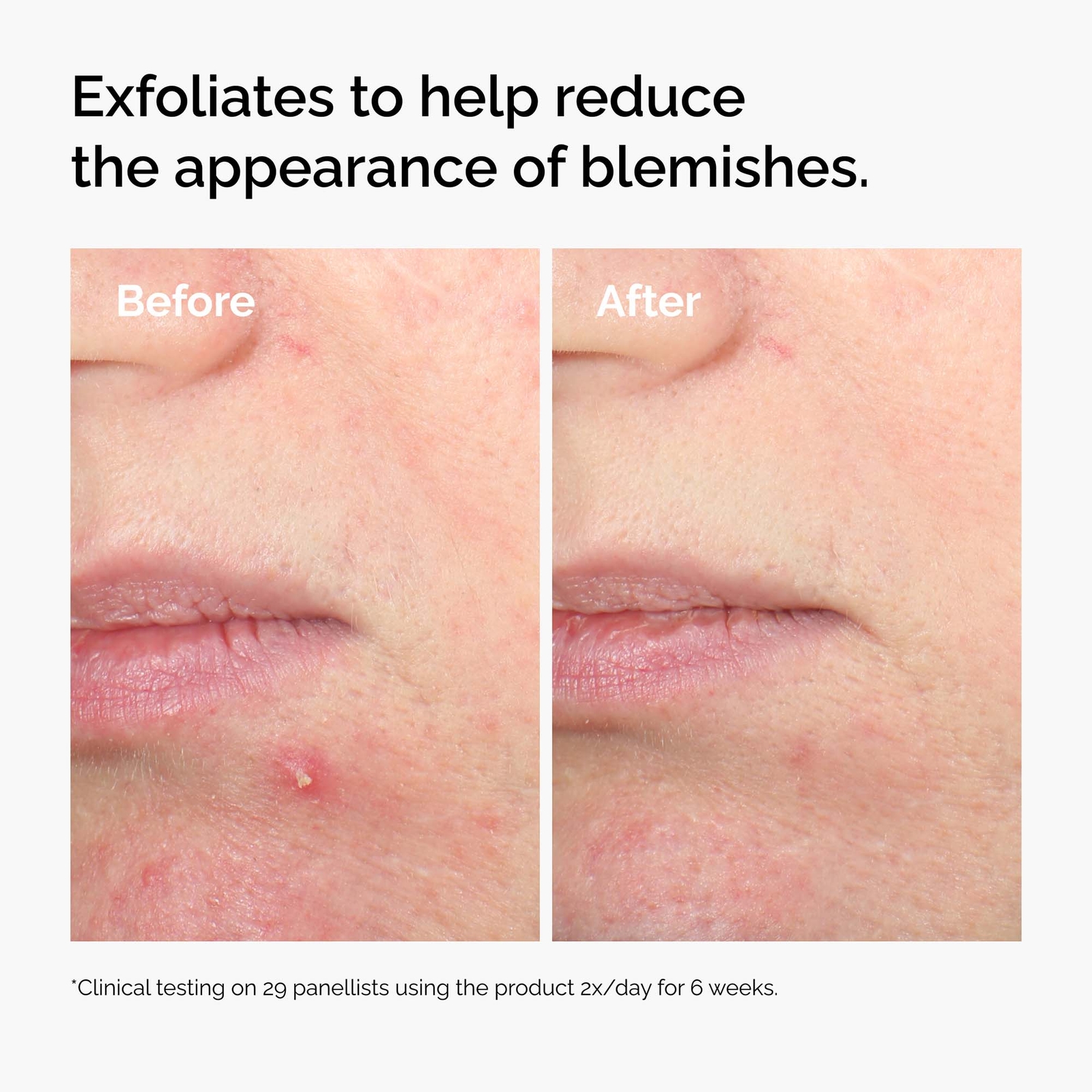 Thumbnail - The Ordinary Salicylic Acid 2% Solution 30 ml