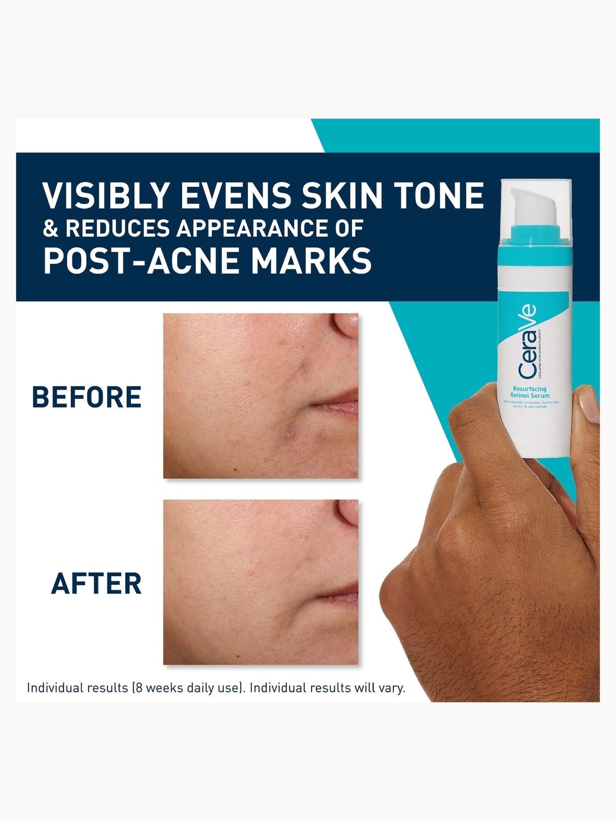 CeraVe Resurfacing Retinol Serum with Ceramides and Niacinamide for Blemish-Prone Skin 30ml 4