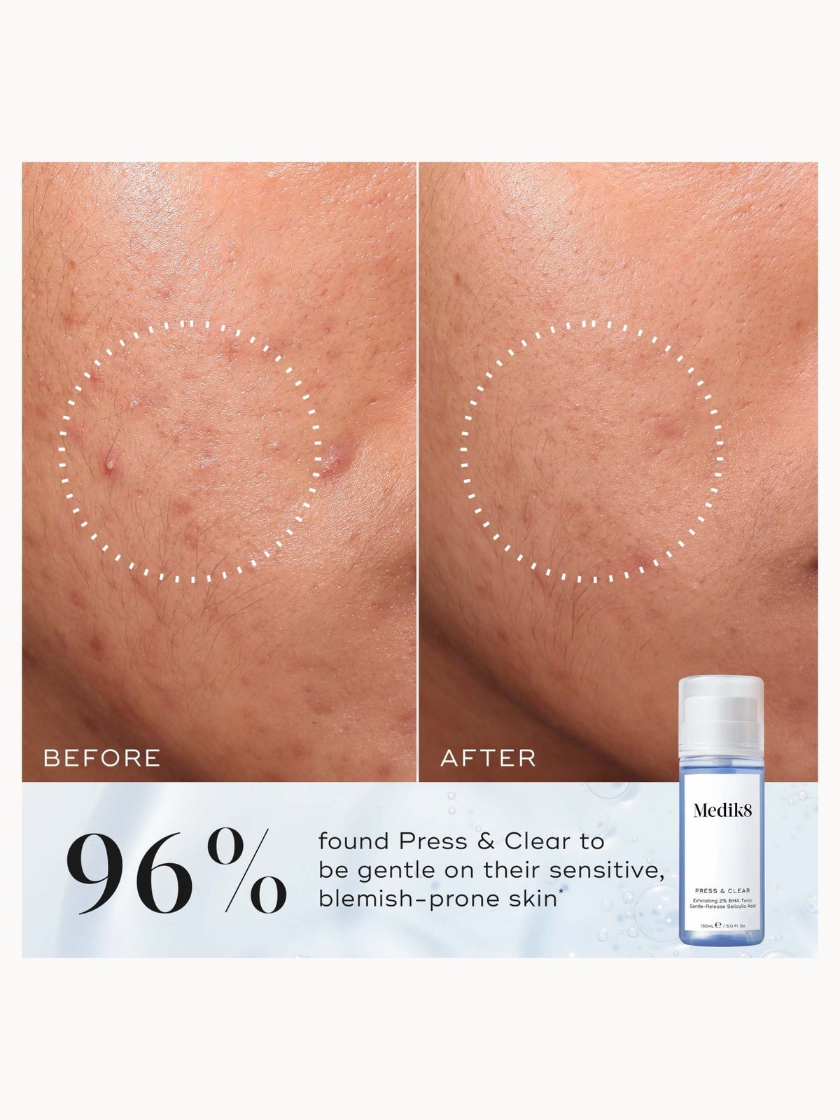 Medik8 Press and Clear 150ml (Various Options) - 150ml Refill 3