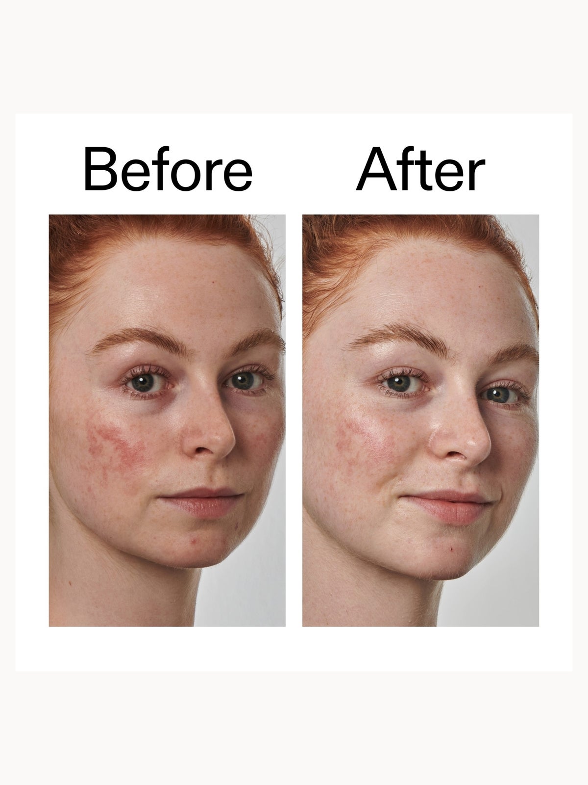 The INKEY List Super Solutions 10% Azelaic Acid Serum 30ml 2