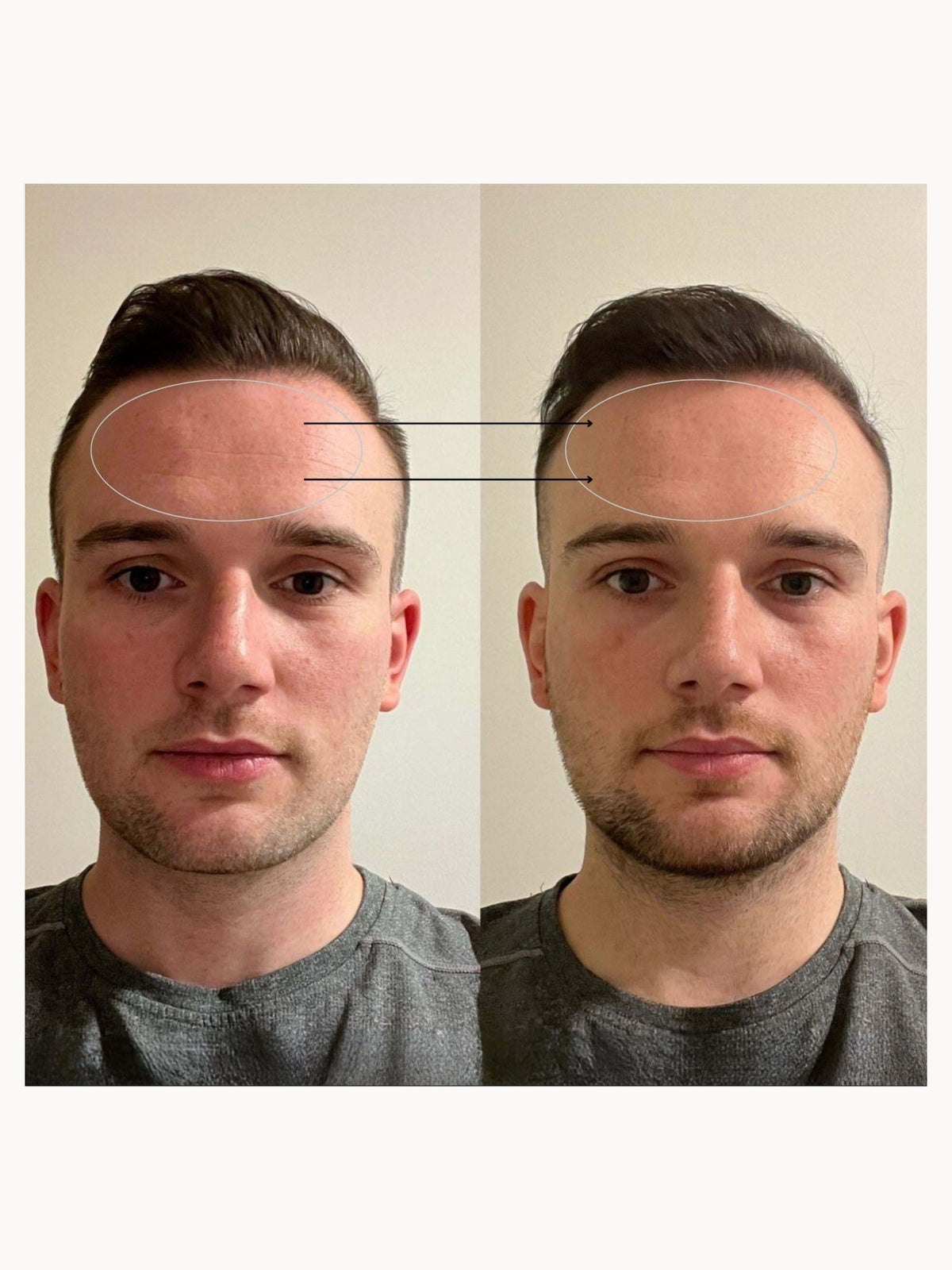 BEAUTYPRO LED Mask Device 4