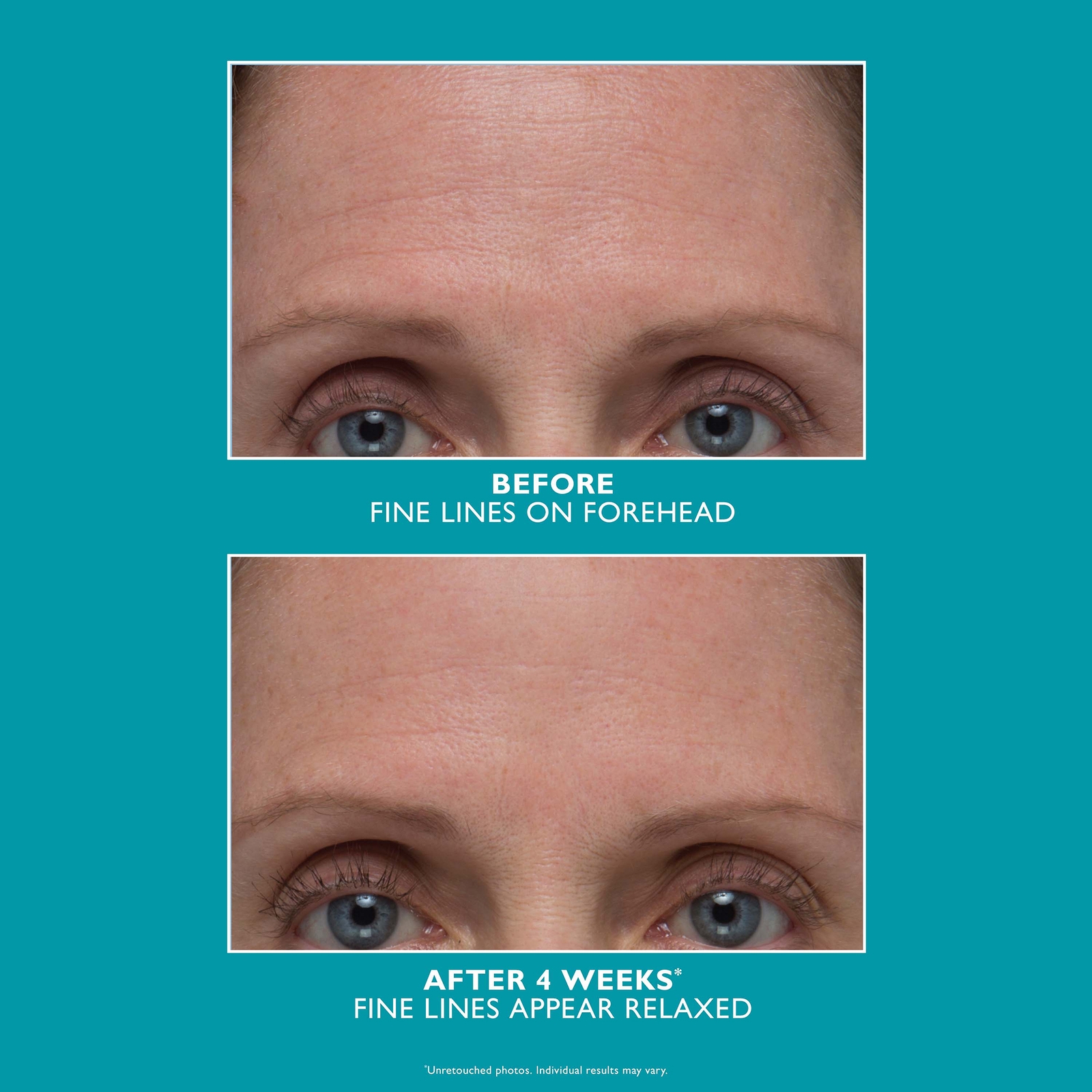 Thumbnail - Peter Thomas Roth Peptide Skinjection Amplified Wrinkle-Fix Refillable Serum 30ml