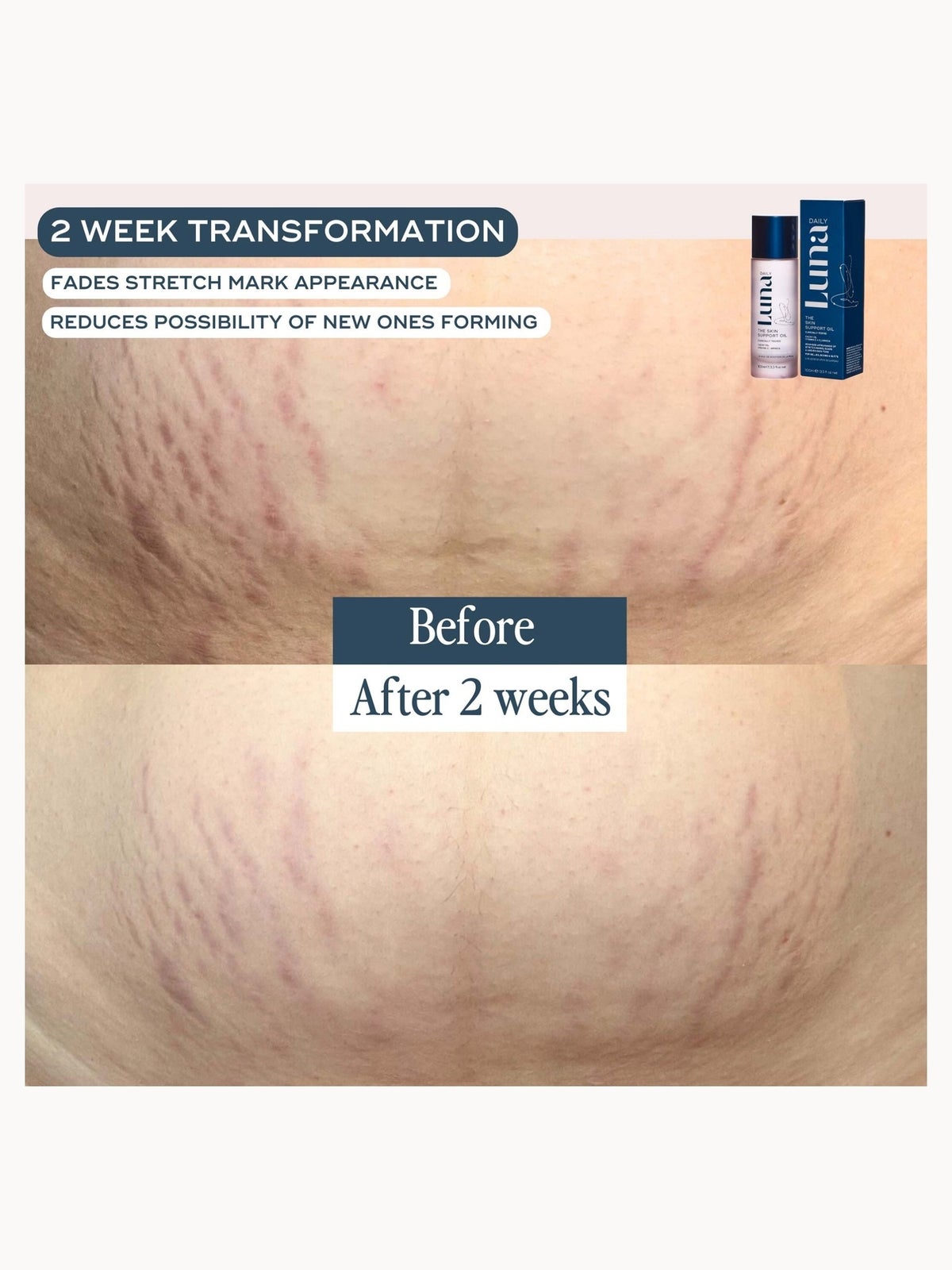 Luna Daily The Skin Support Oil for Stretch Marks and Hyperpigmentation 100ml 4