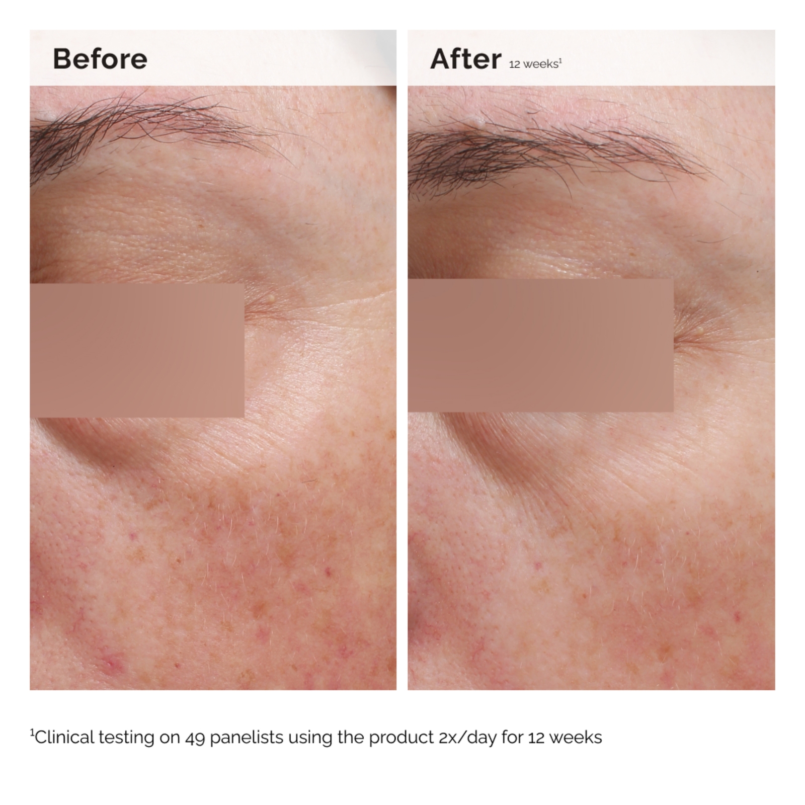 Thumbnail - The Ordinary Niacinamide 5% Face and Body Emulsion 100ml