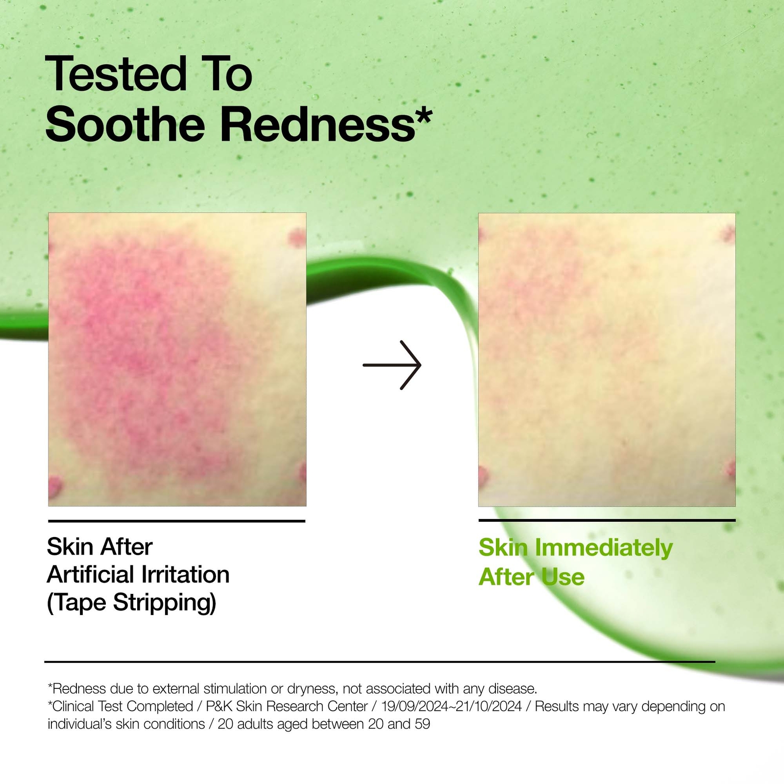 Thumbnail - Anua Azelaic Acid 10 Hyaluron Redness Soothing Serum 30ml