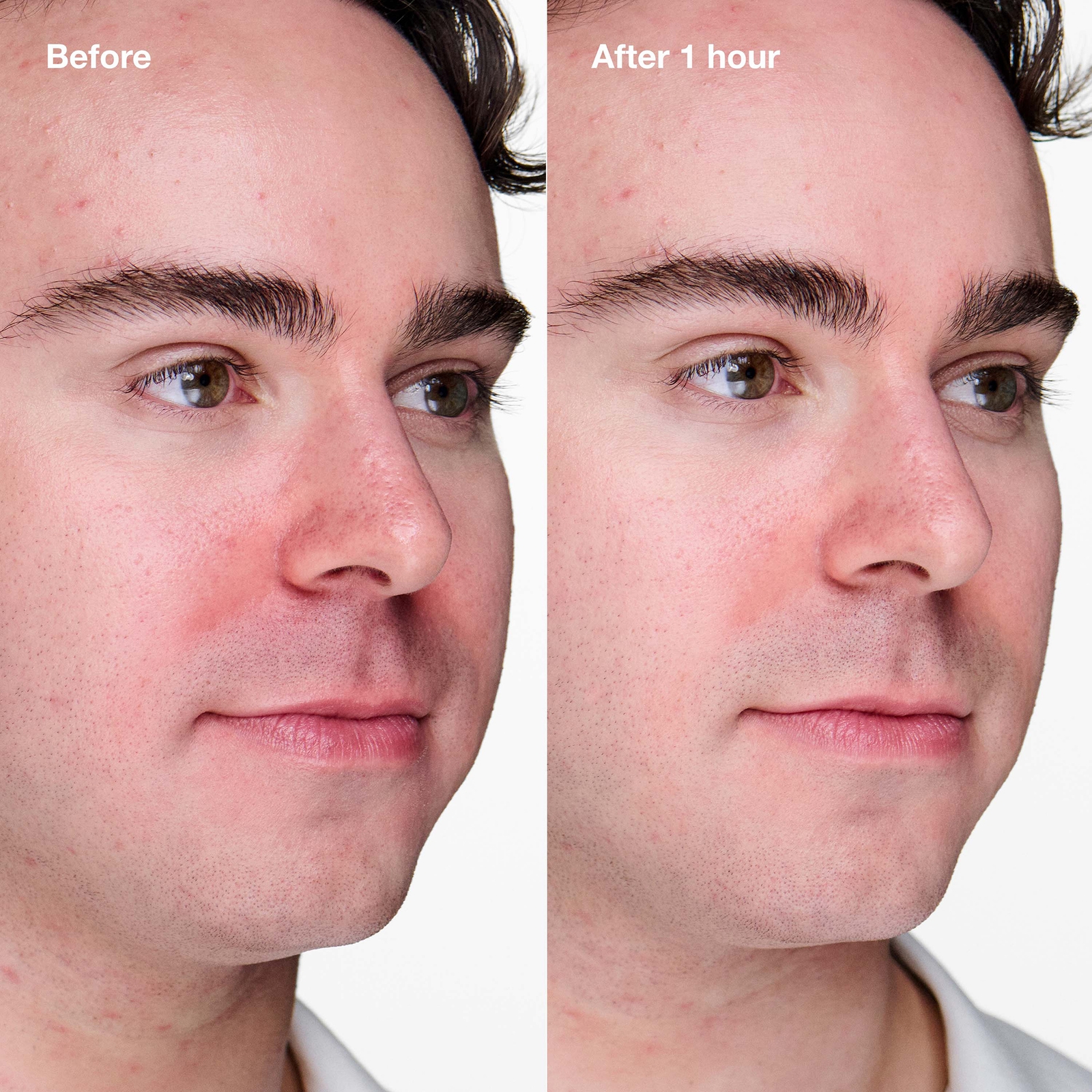 Thumbnail - Clinique Anti-Blemish Solutions Clinical Advanced Clearing Gel 10ml