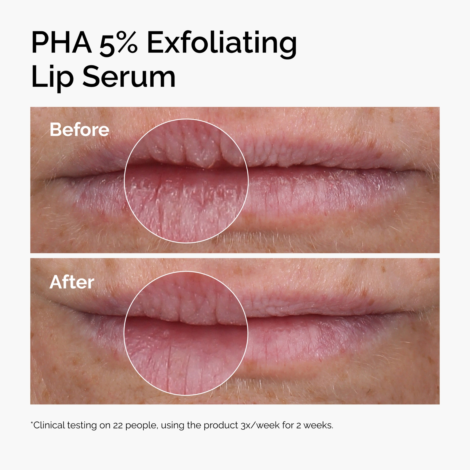 Thumbnail - The Ordinary PHA 5% Exfoliating Lip Serum 15ml